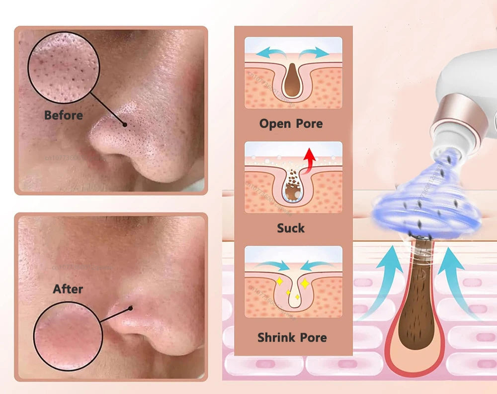 Porely - DeepClean™ Porensauger